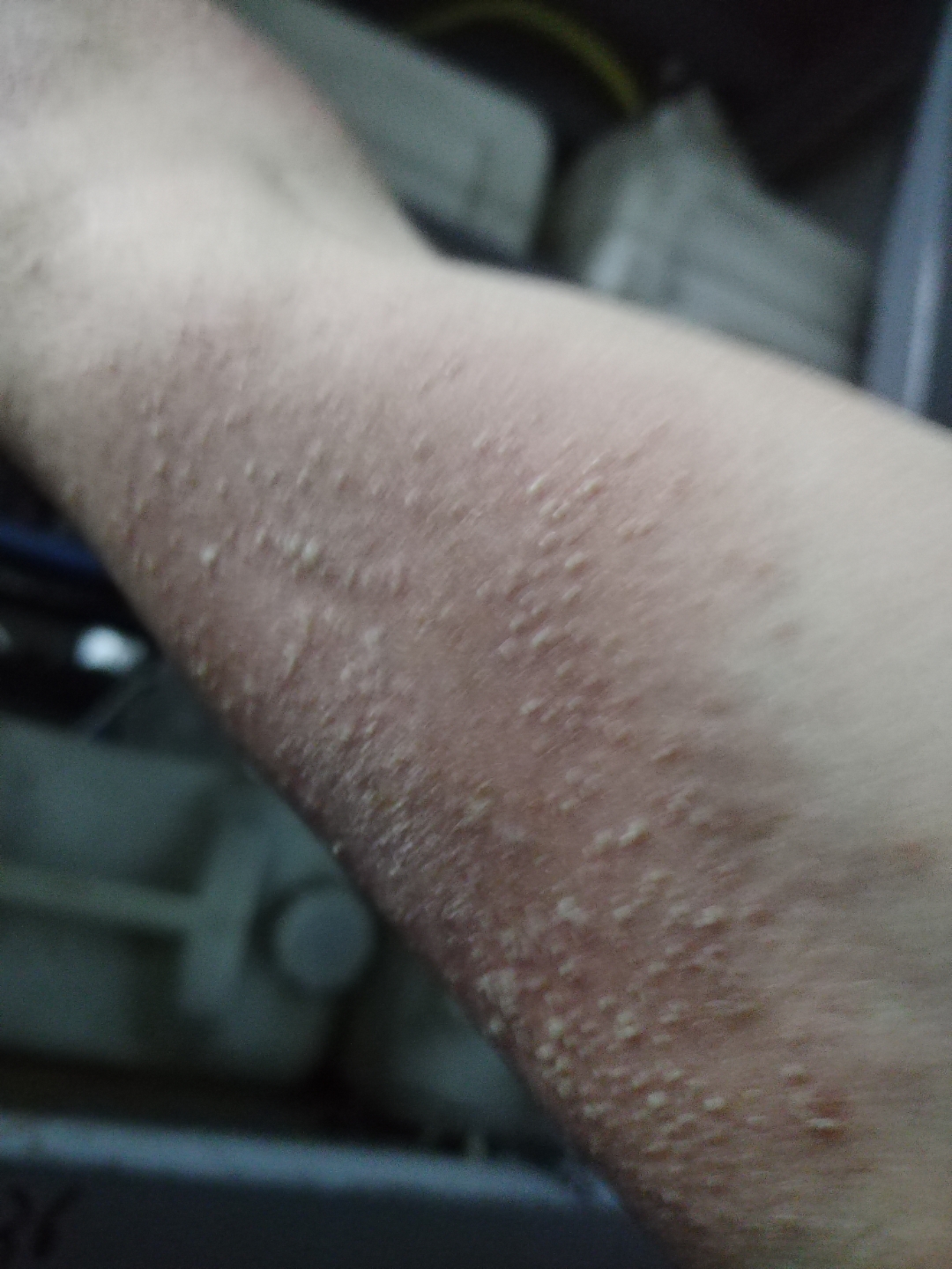 三友饵料过敏(饵料过敏起小水泡)