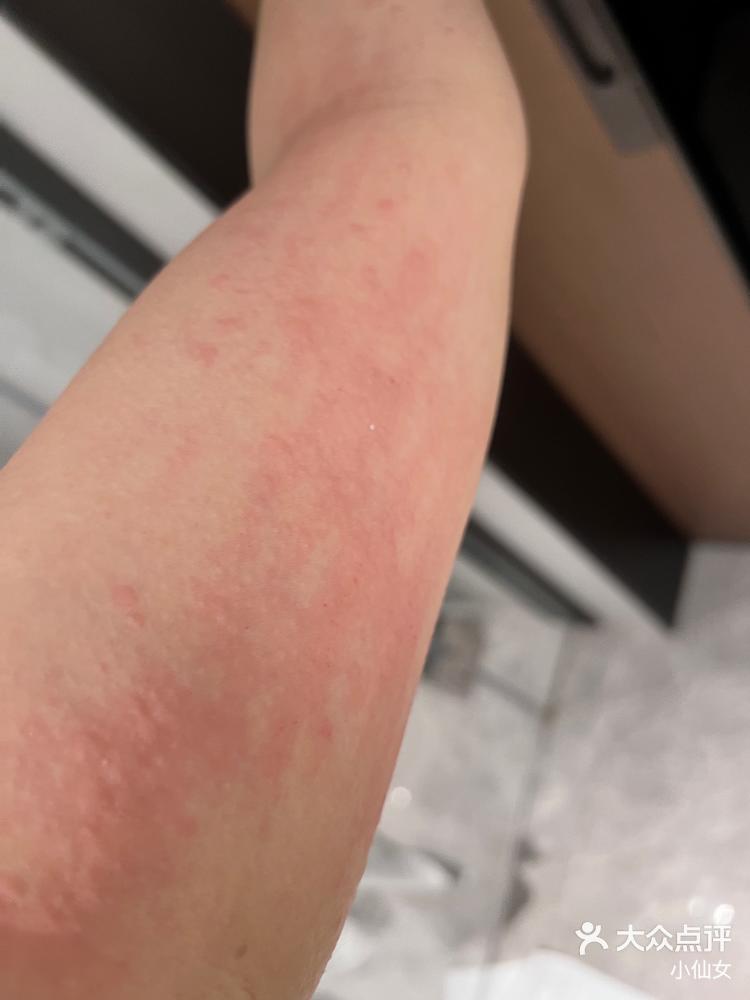 三友饵料过敏(饵料过敏起小水泡)