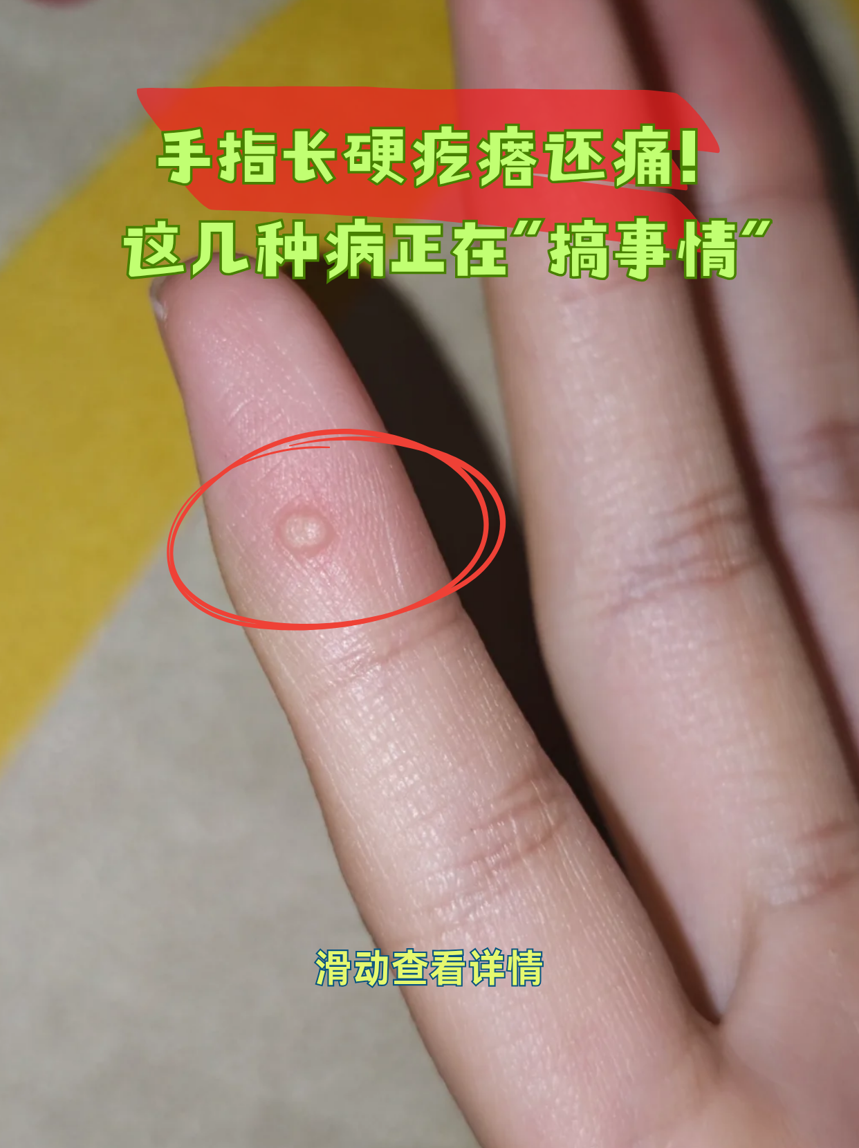 防止饵料烧手(饵料烧手用什么药膏) 防止饵料烧手(饵料烧手用什么药膏)