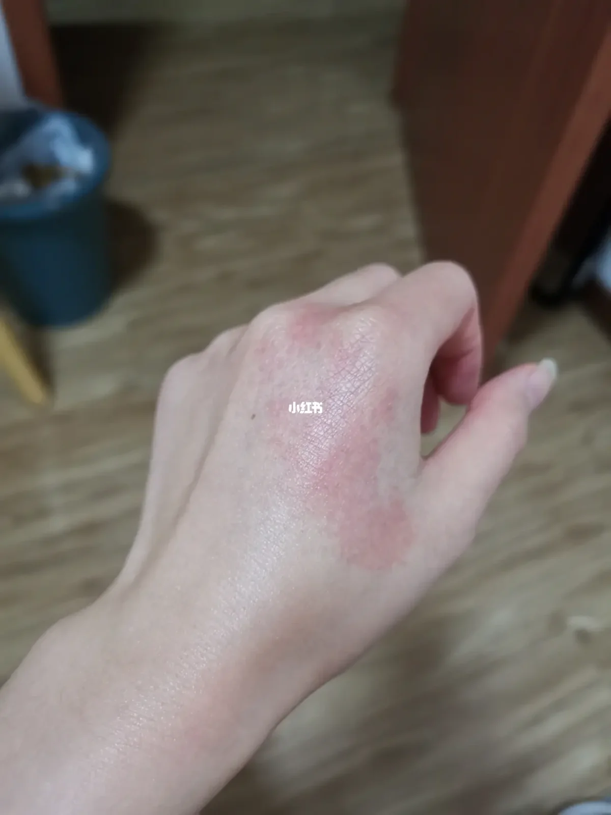 调饵料后手过敏(钓鱼饵料手皮肤过敏怎么根治) 调饵料后手过敏(钓鱼饵料手皮肤过敏怎么根治)