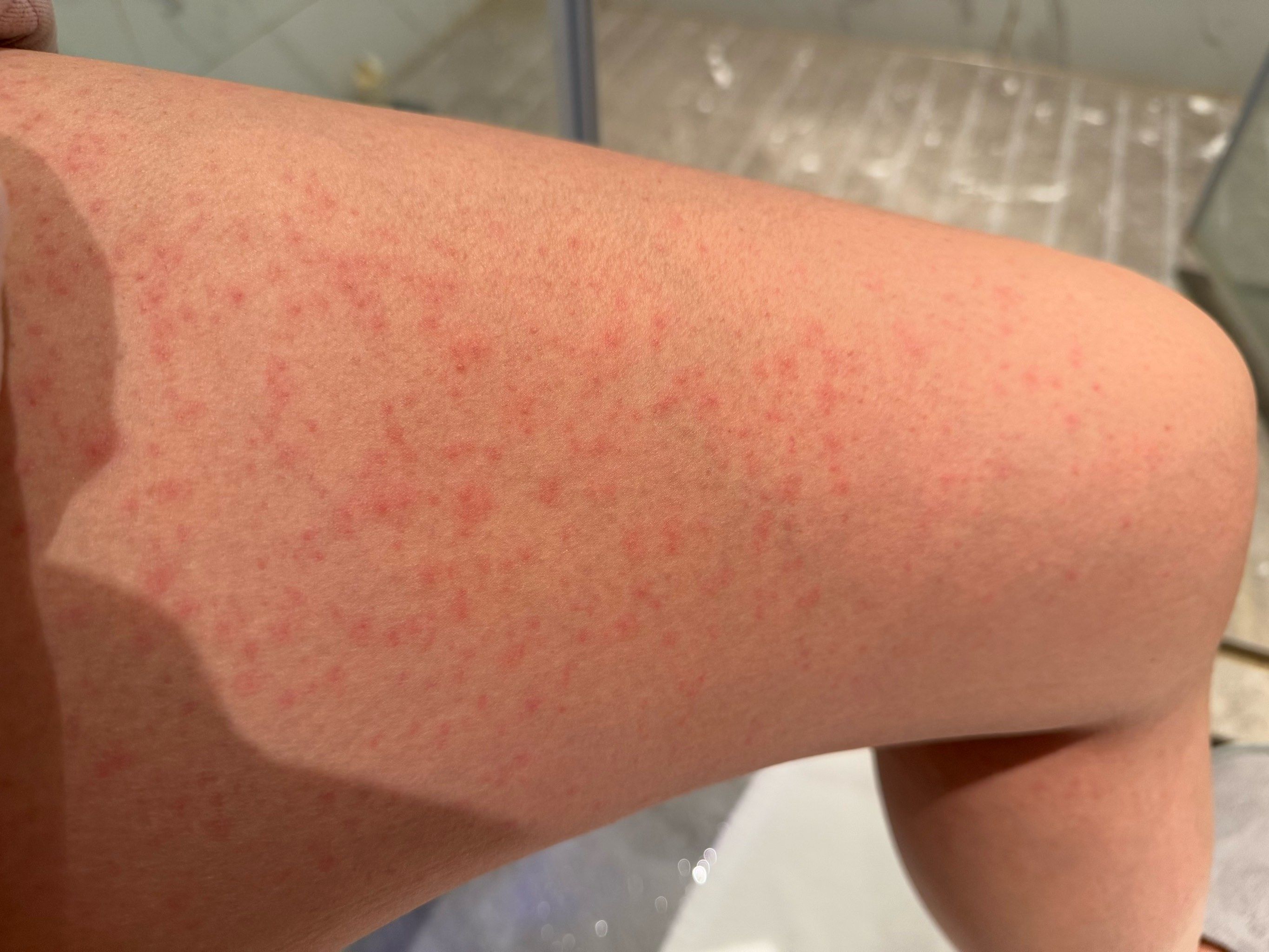 钓鱼饵料过敏图片(钓鱼饵料过敏图片大全)