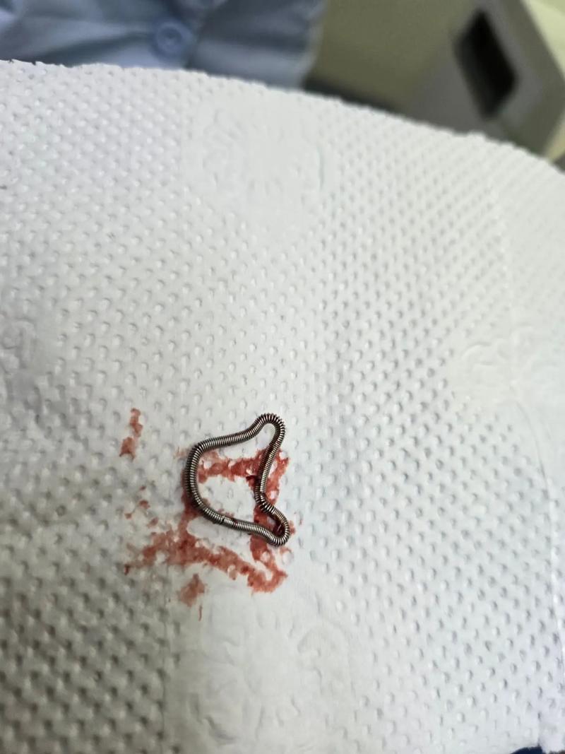 路亚环脱落(路亚导环开裂)