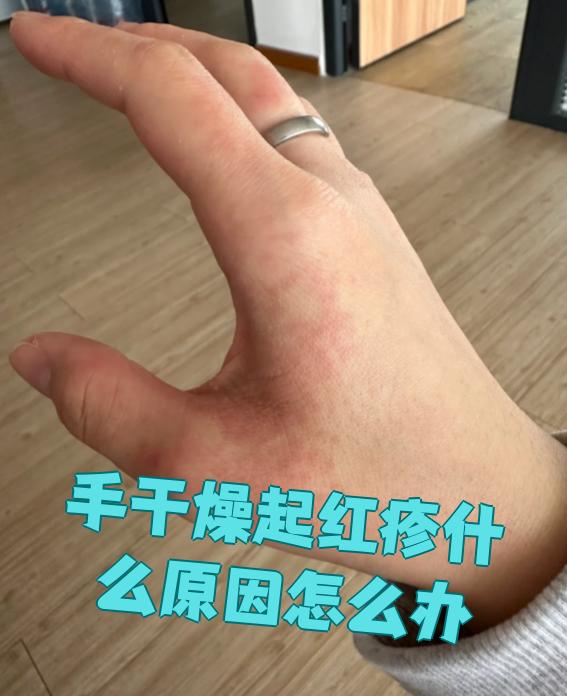 什么饵料手过敏(钓鱼饵料手过敏的福音)